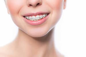 Braces in bangalore