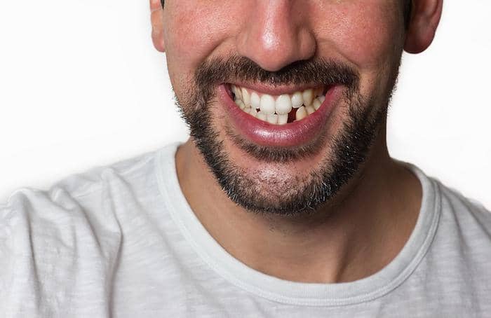 Отсутствие одного или нескольких зубов: осложнения и варианты лечения