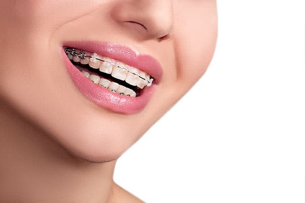 Выпрямление зубов – обзор ортодонтического лечения